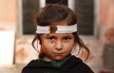 5003 226x145 - An Afghani Injured Girl