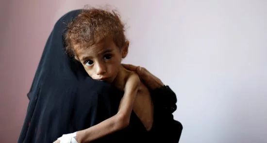 181025 yemen famine mc 1048 1ddb6f0689f1ae0f0d8c904ae79e5233 550x295 - Khashoggi Versus 50,000 Slaughtered Yemeni Children