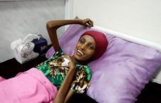 یمنی 226x145 - سوء تغذیه شدید دختر 18 ساله یمنی پس از جنایات عربستان
