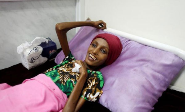 سوء تغذیه شدید دختر 18 ساله یمنی پس از جنایات عربستان