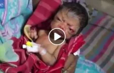 ویدیو/ ولادت نوزادی عجیب الخلقه در بنگله دیش!