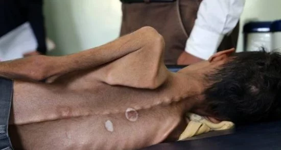 بحران انسانی در یمن؛ ناظران سازمان ملل هشدار دادند
