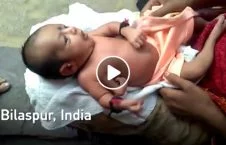 ویدیو/ تولد نوزاد سه دست در هند
