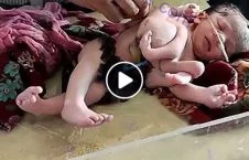 ویدیو/ ولادت نوزادی عجیب الخلقه با 3 دست و 4 پا در هند