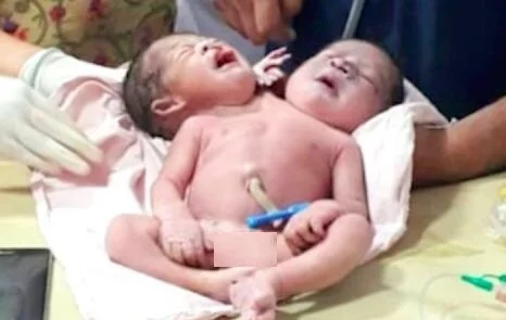 ولادت یک طفل عجیب‌الخلقه در هند + تصاویر