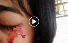 ویدیو/ این دختر هندی خون گریه می کند