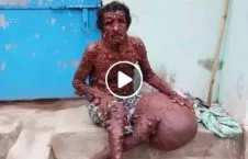 ویدیو/ مرضی که مرد هندی را ترسناک کرده است