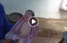 ویدیو/ ولادت یک نوزاد عجیب الخلقه در هند