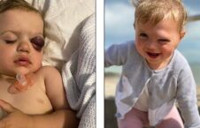 طفل ۲ ساله ای که به جای اشک خون گریه می‌کند + تصاویر