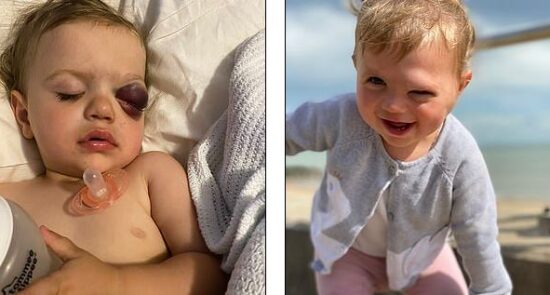 میلی براون 1 550x295 - طفل ۲ ساله ای که به جای اشک خون گریه می‌کند + تصاویر